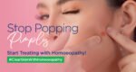 Curing Acne with homoeopathy