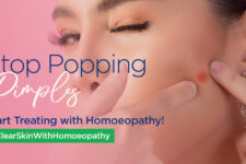 Curing Acne with homoeopathy