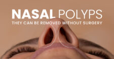 Nasal Polyps: Finding cure with Homeopathic Remedies