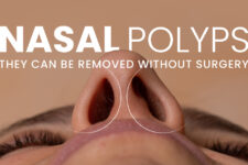 Nasal Polyps: Finding cure with Homeopathic Remedies