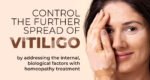 Vitiligo and Exploring Homeopathic Treatment