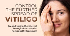 Vitiligo and Exploring Homeopathic Treatment