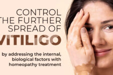 Vitiligo and Exploring Homeopathic Treatment