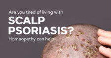 Managing Scalp Psoriasis with Homeopathic Medicines: A Natural Approach to Relief