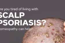 Managing Scalp Psoriasis with Homeopathic Medicines: A Natural Approach to Relief